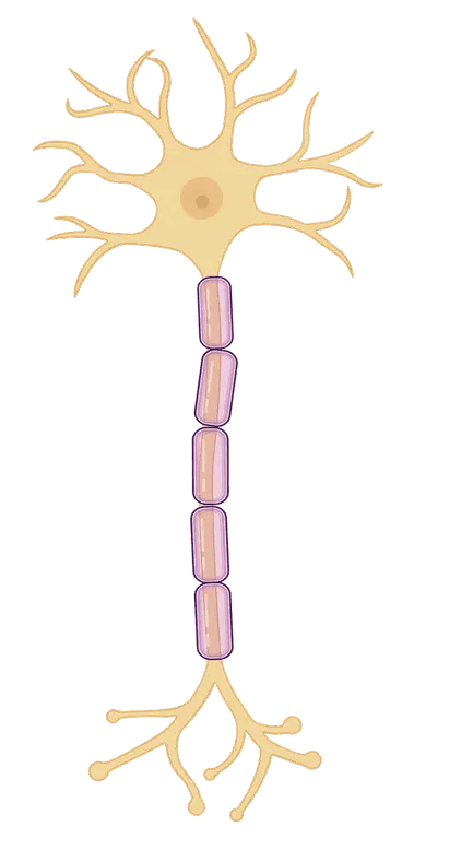 Ilustración de una neurona mostrando desmielinización